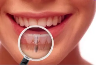 Implante dentário feito por dentistas em Juiz de Fora na Odontoclamp