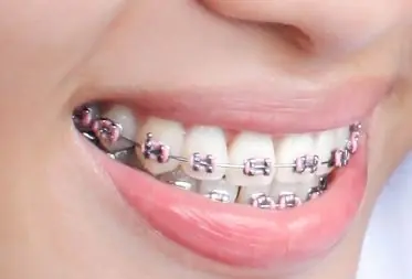 Aparelho ortodôntico instalado por dentistas em Juiz de Fora na Odontoclamp