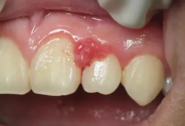 Tratamento periodontal com dentistas em Juiz de Fora na Odontoclamp